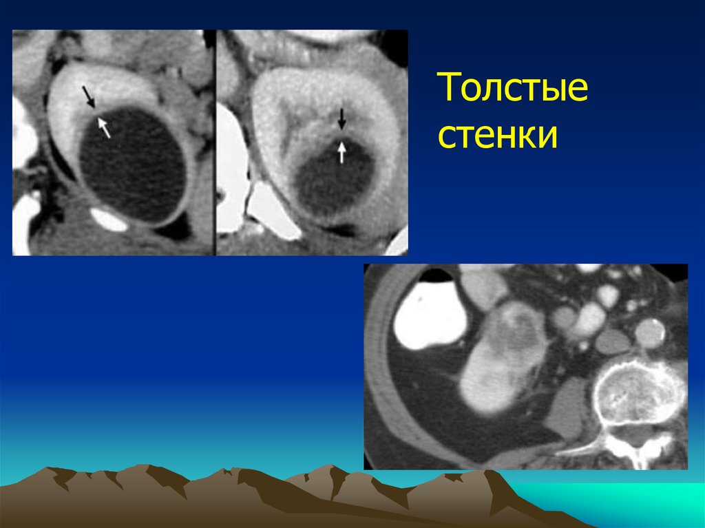 Типы кисты почек