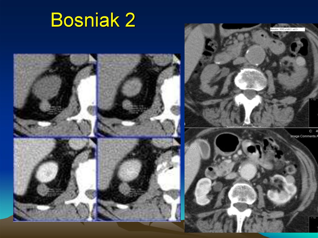 Кисты почек по босняк. Кисты почек кт Босниак. Классификация Босниак кт почек. Геморрагические кисты почки Bosniak.