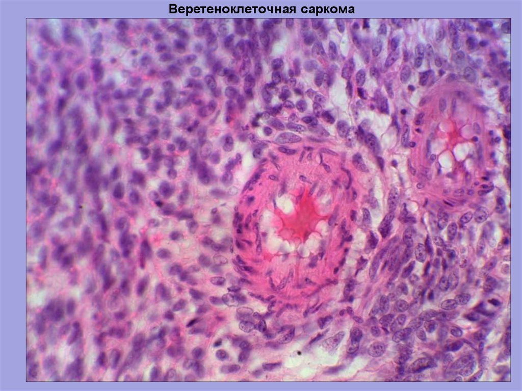 Фибросаркома микропрепарат рисунок