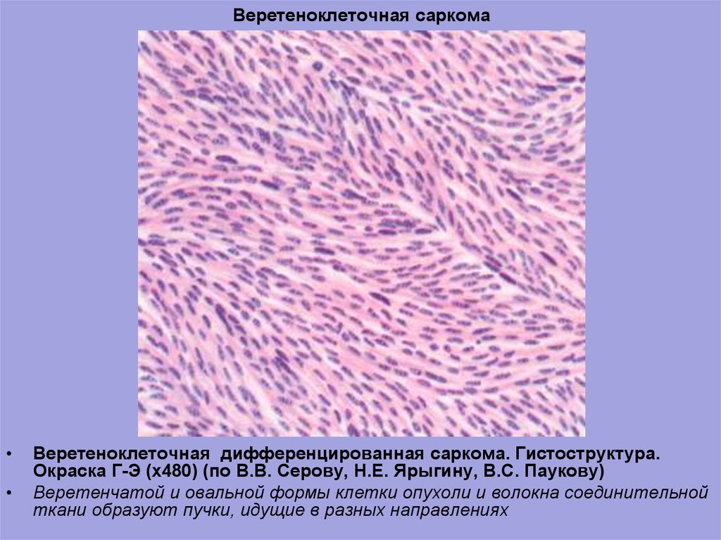 Фибросаркома микропрепарат рисунок