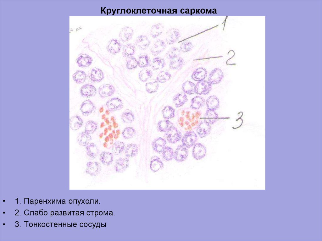 Фибросаркома микропрепарат рисунок