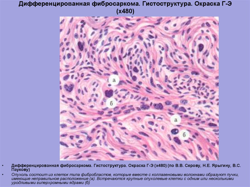 Фиброма микропрепарат рисунок