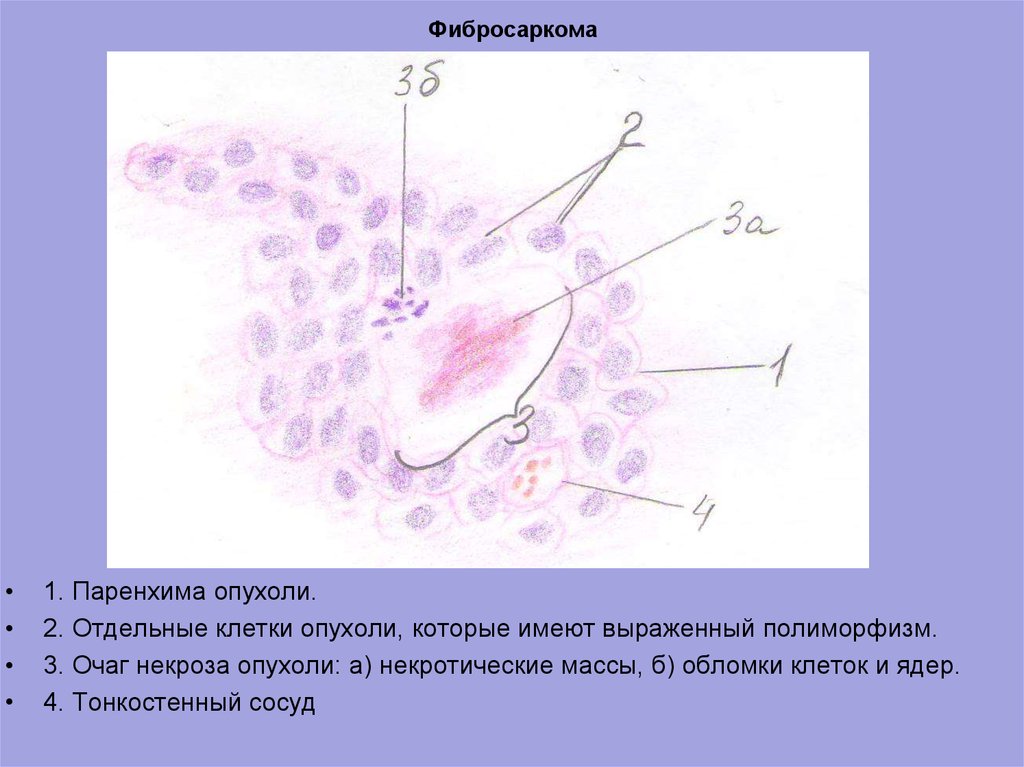 Фибросаркома микропрепарат рисунок