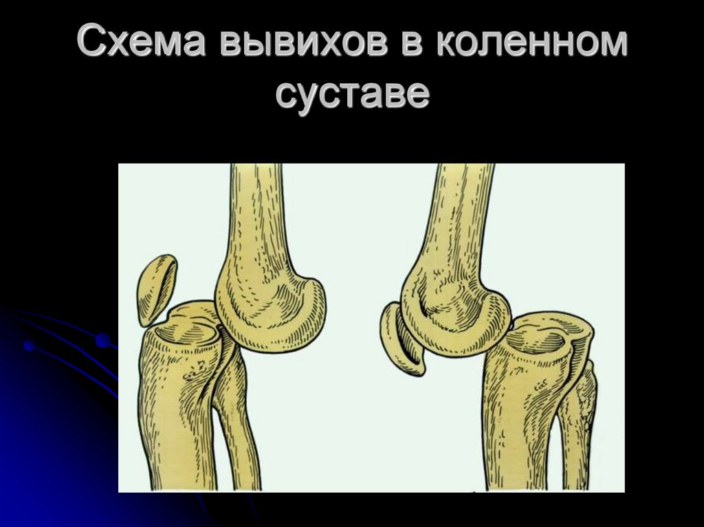 Вывих и подвывих схема