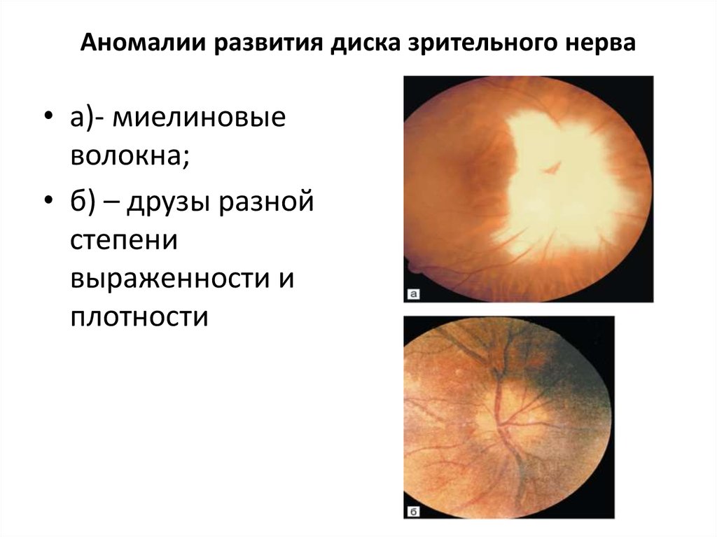 Аномалия развития зрительного нерва. Миелиновые волокна ДЗН. Глазное дно миелиновые волокна. Патология ДЗН миелиновые волокна. Врожденные аномалии зрительного нерва.