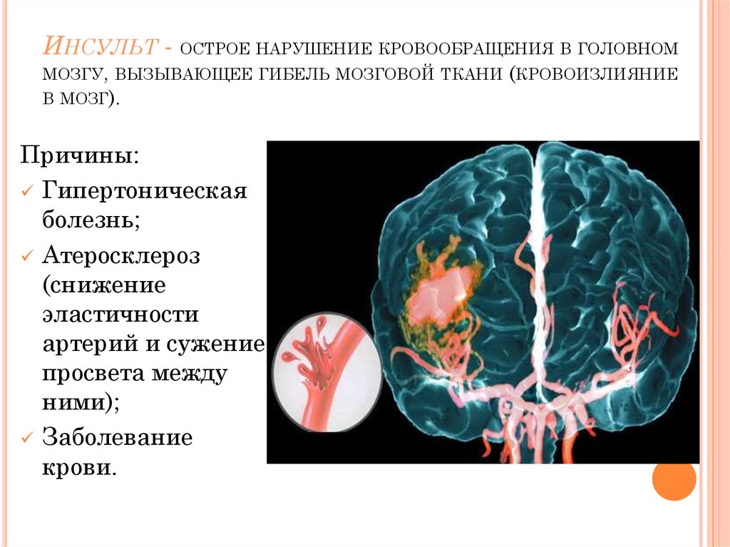 Причинами инсульта могут быть. Нарушение кровообращения головного мозга. Нарушение кровоснабжения головного мозга. Резкое нарушение кровообращения мозга это. Кровоизлияние в головной мозг.