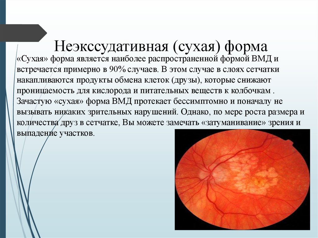 Возрастная макулярная дегенерация презентация