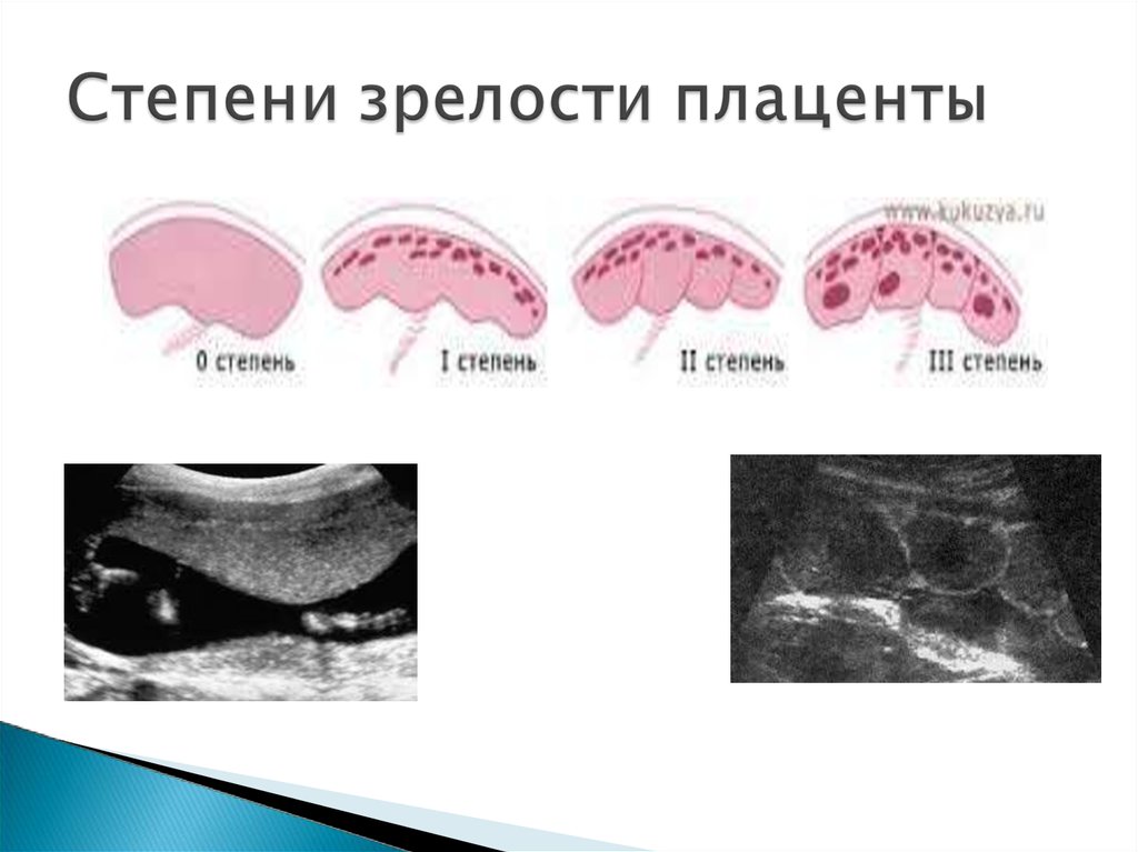 Степень зрелости плаценты 37 недель. Степени зрелости плаценты по неделям беременности таблица по УЗИ. Плацента 3 степени зрелости УЗИ. 4 Степени зрелости плаценты. Преждевременное созревание плаценты УЗИ.