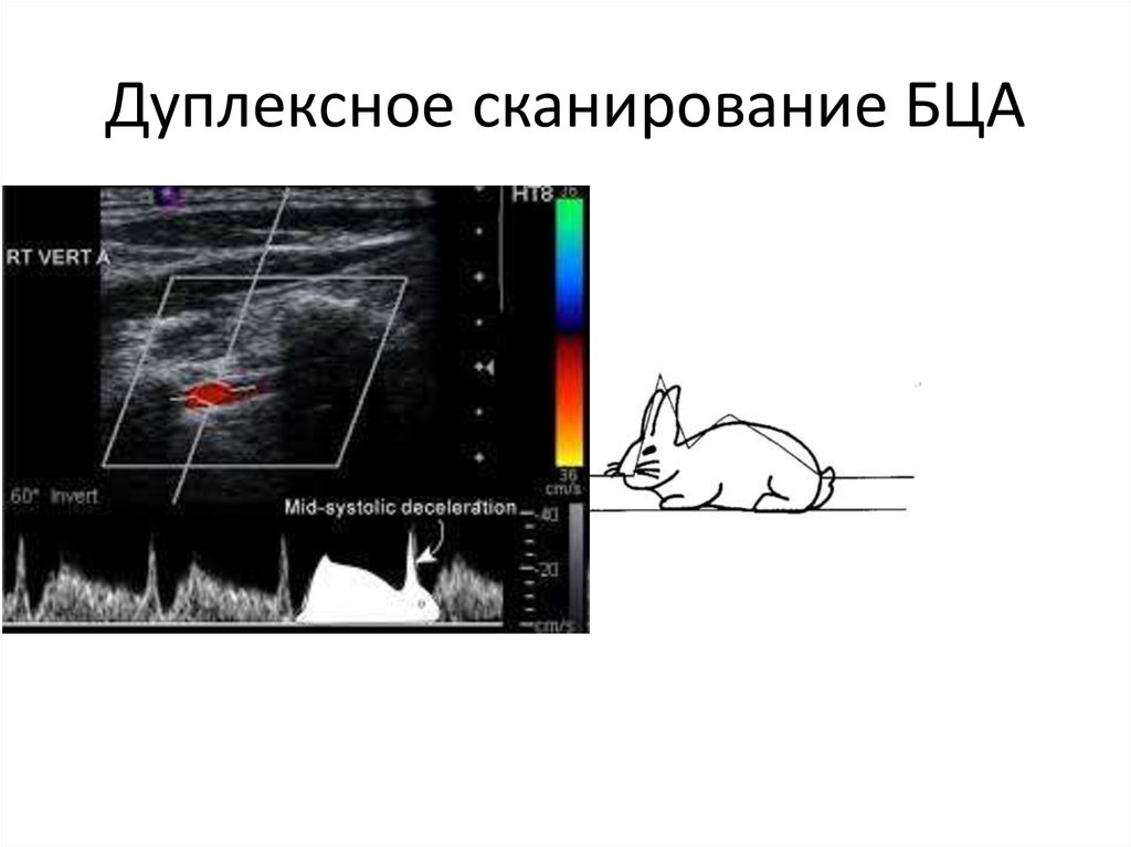 Брахиоцефальное сканирование. Дуплексное сканирование брахиоцефальных артерий. Дуплексное сканирование бца. Дуплексное сканирование брахиоцефальных артерий (бца);. Дуплексное сканирование ПБА.