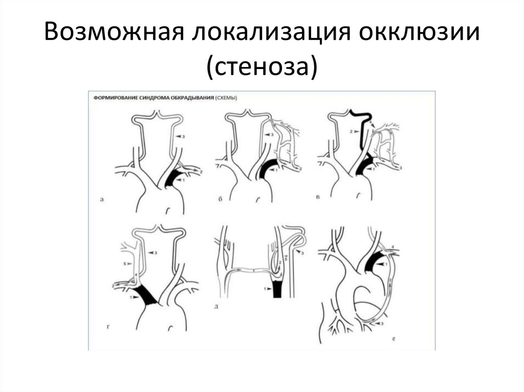 Стил синдром схема