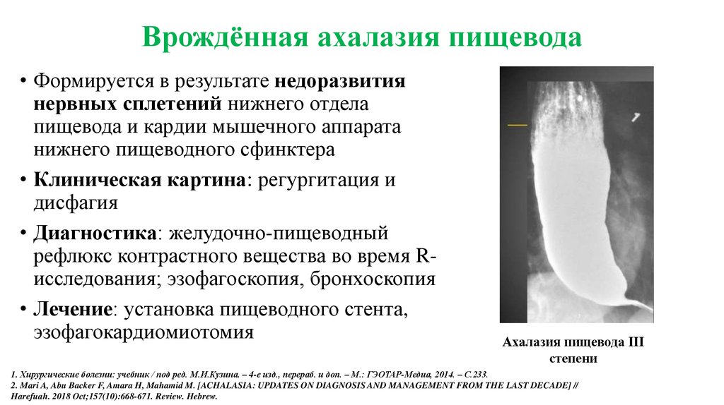 Какой из перечисленных симптомов является ведущим в рентгенологической картине ахалазии пищевода