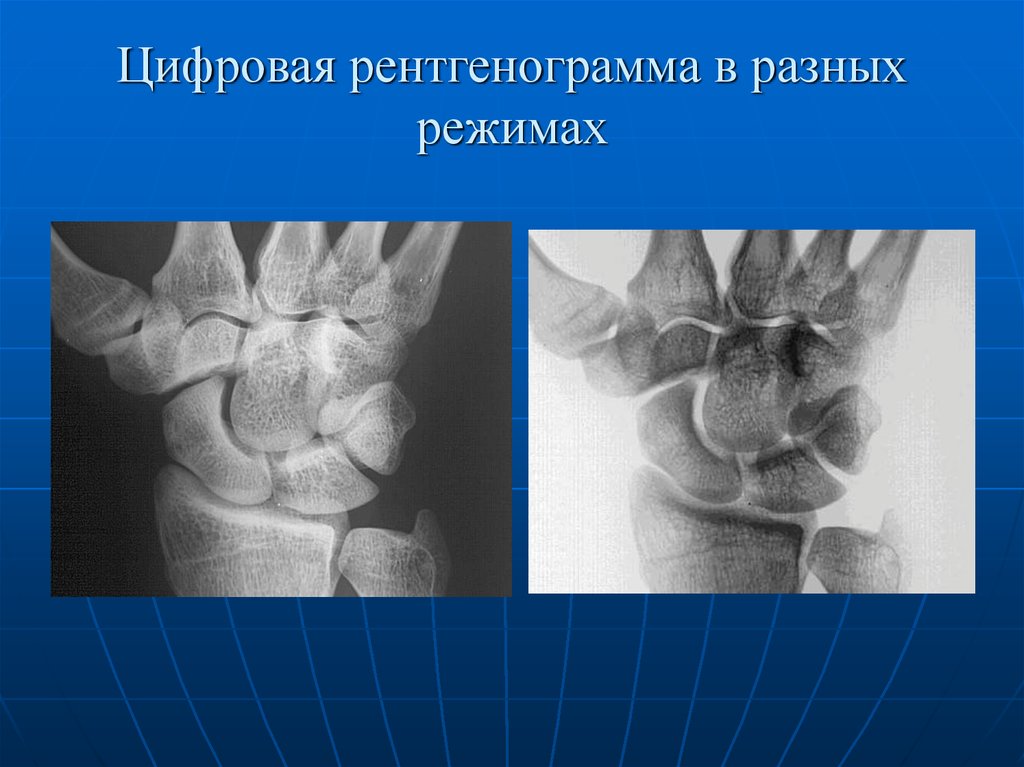 Обычное изображение получаемое при помощи рентгеновских лучей