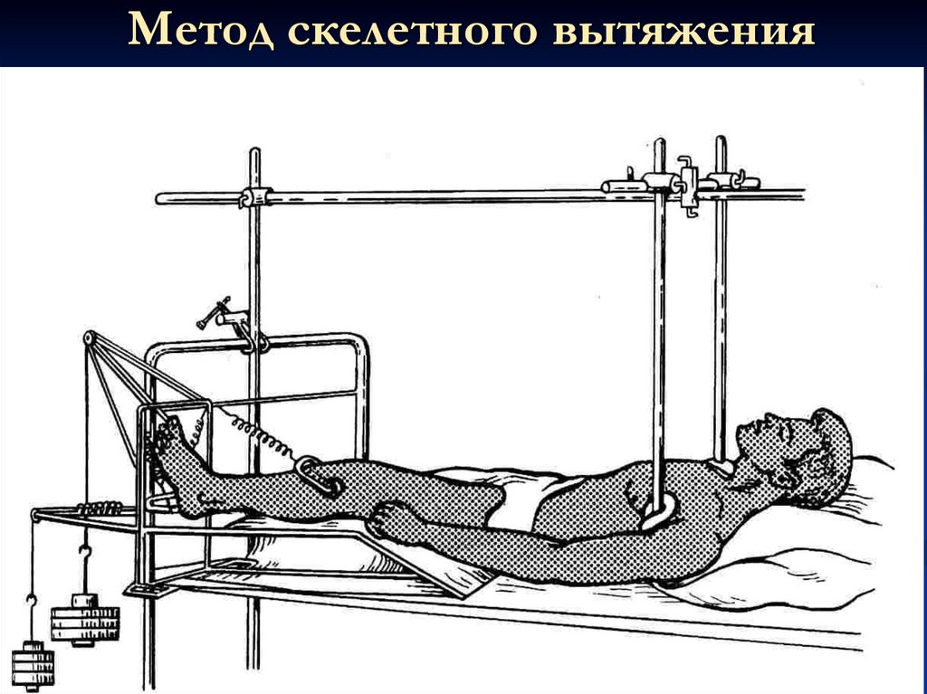 Вытяжение голени. Скелетное вытяжение Беллера. Скелетное вытяжение перелома. Скелетное вытяжение при переломе голени техника. Метод скелетного вытяжения при переломе.