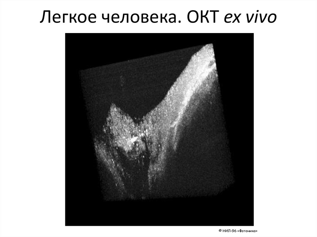Легкое человека. ОКТ ex vivo