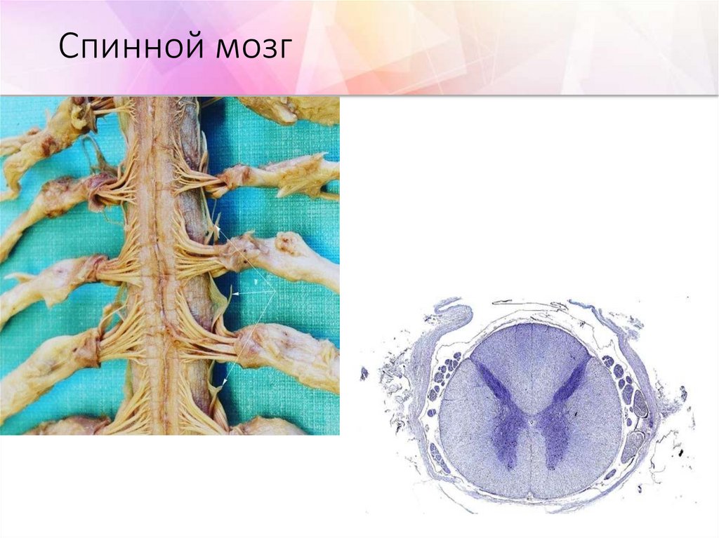 Опухоли спинного мозга презентация