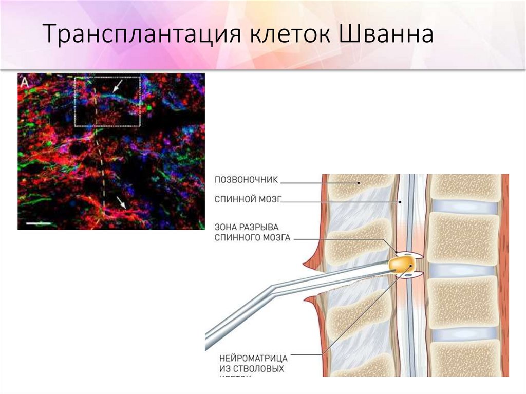Пересадка клеток мозга. Трансплантация спинного мозга. Трансплантация шванновских клеток. Клетки спинного мозга. Стволовые клетки спинного мозга.