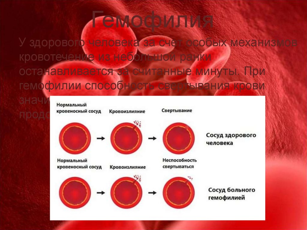 Гемофилия и железо