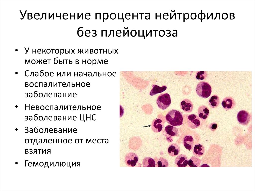 Лейкоцитоз нейтрофилы