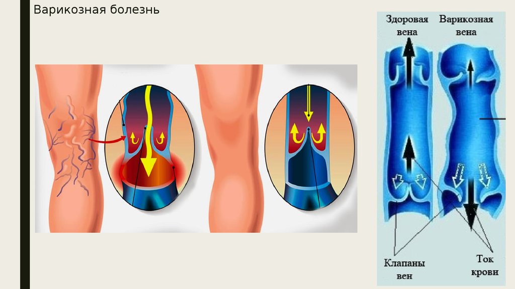 Варикозная болезнь вен нижних конечностей мкб. Варикозное расширение вен. Варикозная болезнь анатомия. Варикозная болезнь вен нижних конечностей.