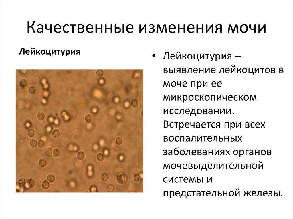 Лейкоцитурия характерна для