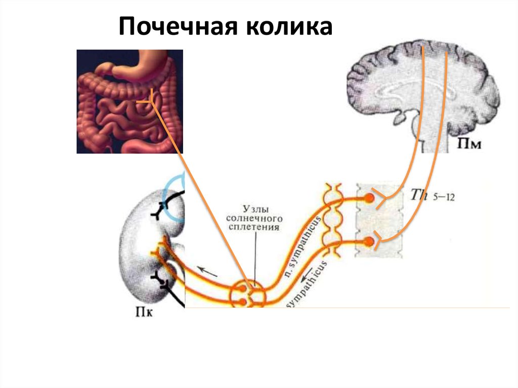 Почечная колика