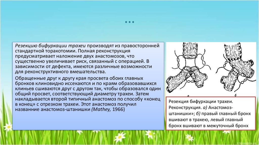 Тест рак трахеи по утвержденным клиническим рекомендациям. Циркулярная резекция трахеи. Резекция бифуркации трахеи. Циркулярная резекция трахеи показания.