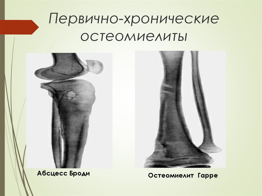 Эпифизарный остеомиелит у детей презентация