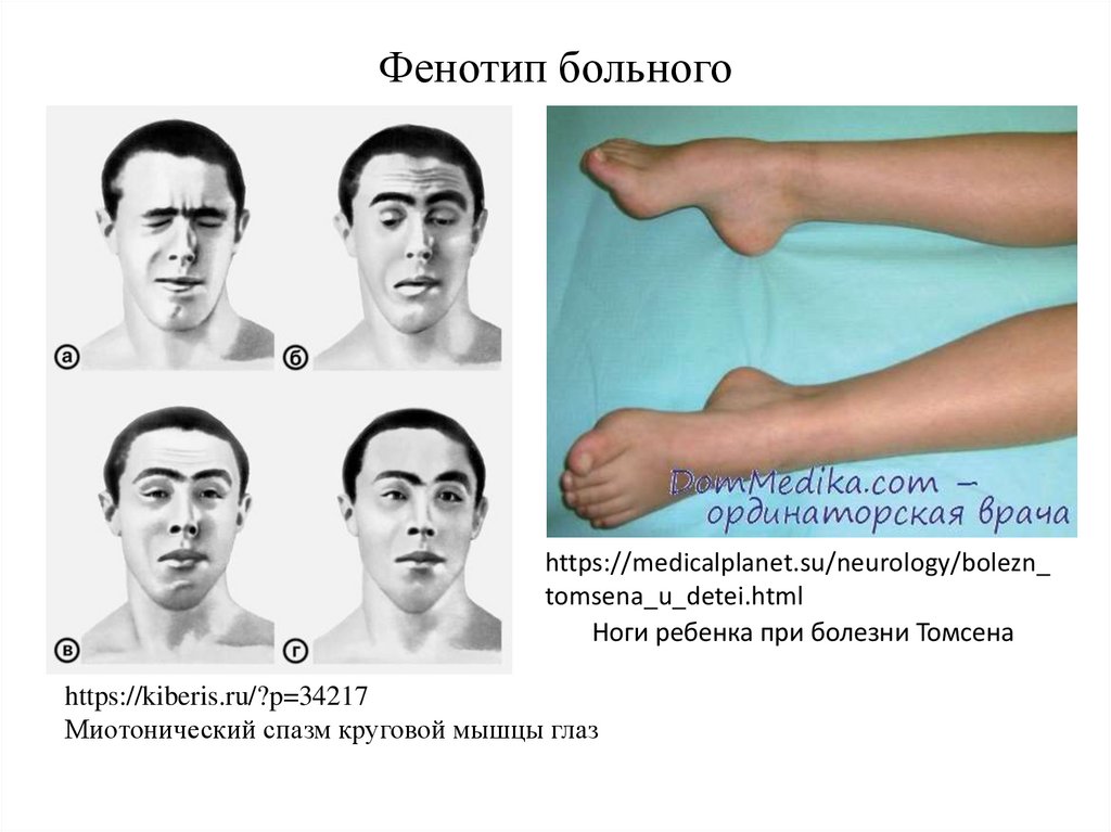 Миотоническая дистрофия. Миотония Томсена/Беккера симптомы.