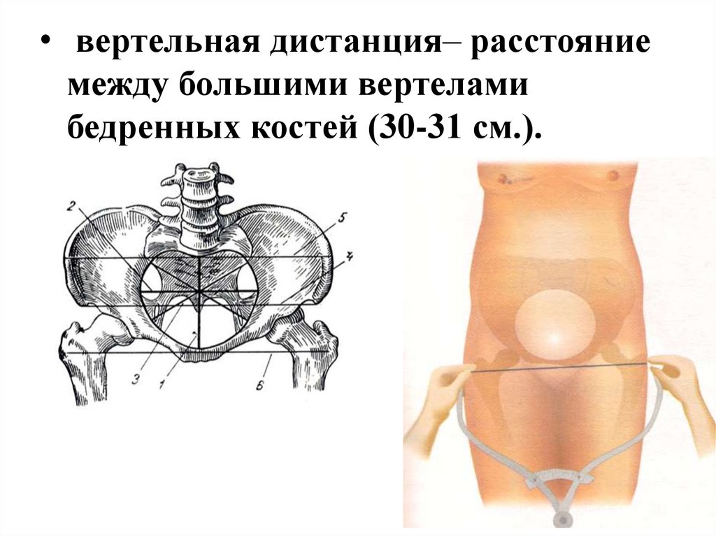 Расстояние между костями. Большими вертелами бедренных костей. Вертельная дистанция. Женский таз презентация.