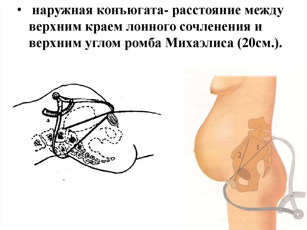 Между верхний. Наружная конъюгата. Наружная конъюгата таза. Измерение наружной конъюгаты таза. Conjugata externa (наружная конъюгата).