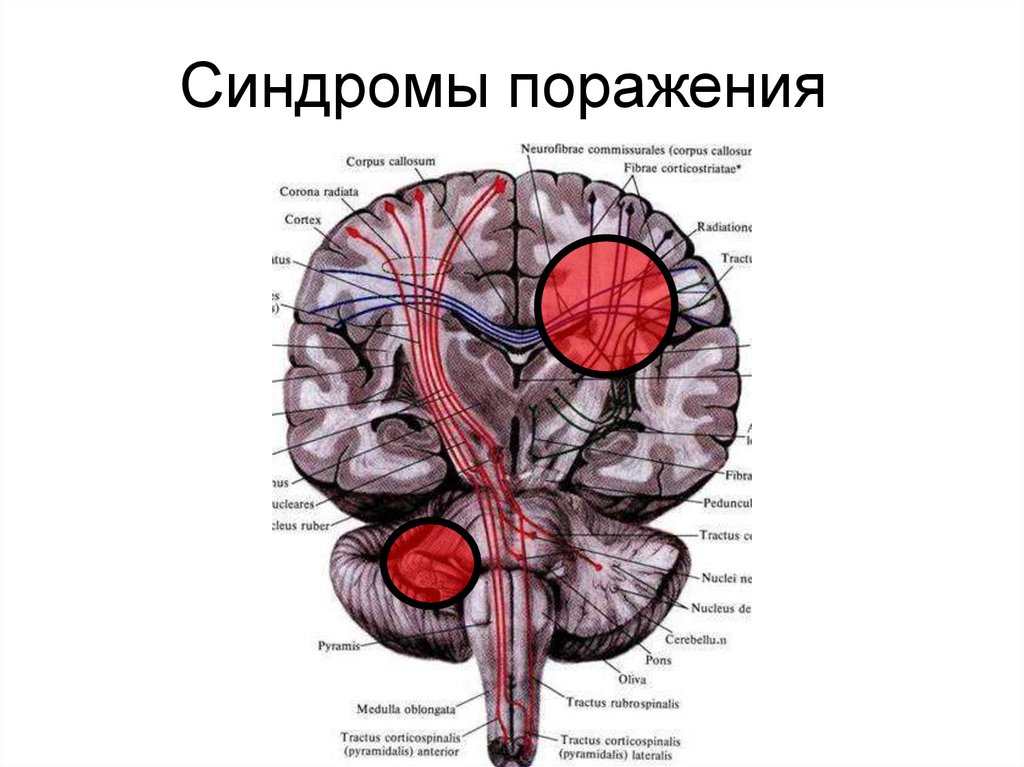 Двигательная сфера. Поражение двигательной сферы. Синдромы поражения двигательной сферы. Двигательная сфера неврология. Синдромы поражения n Opticus.