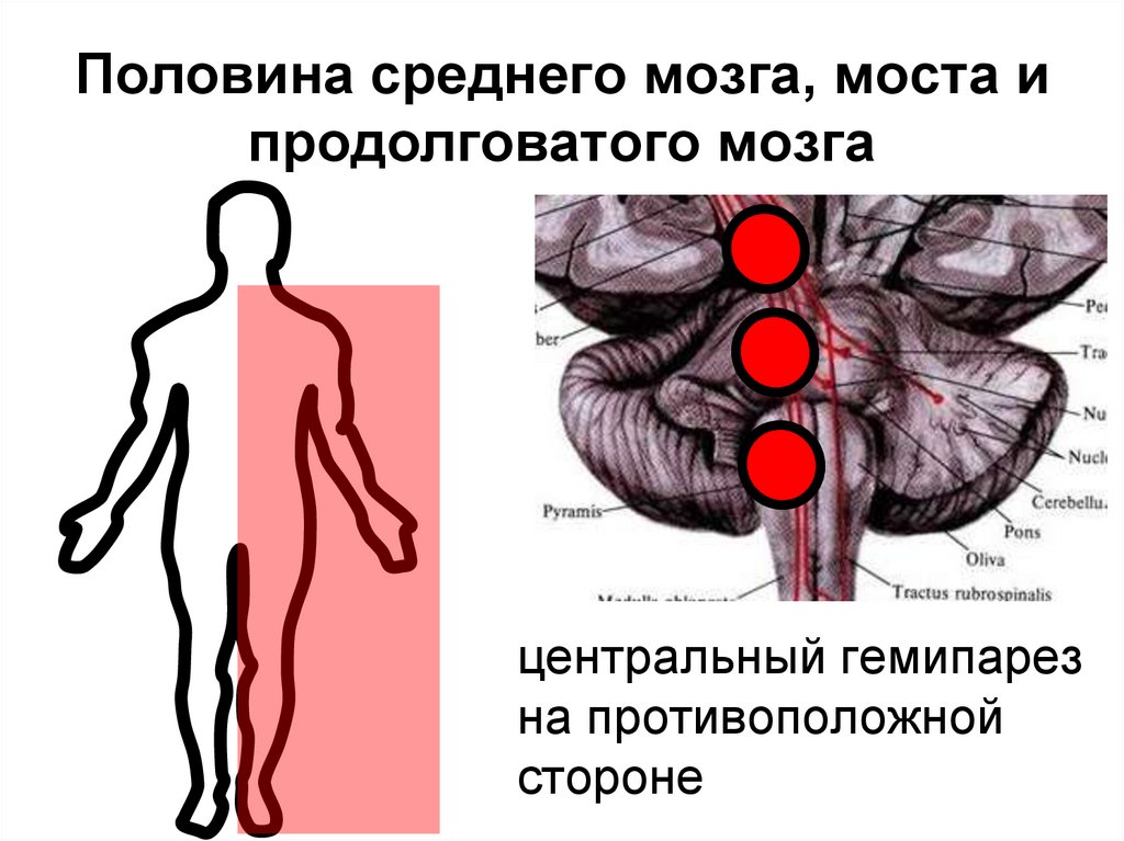 Центральный гемипарез. Синдромы среднего мозга. Синдромы поражения среднего мозга. Синдромы продолговатого мозга и моста.