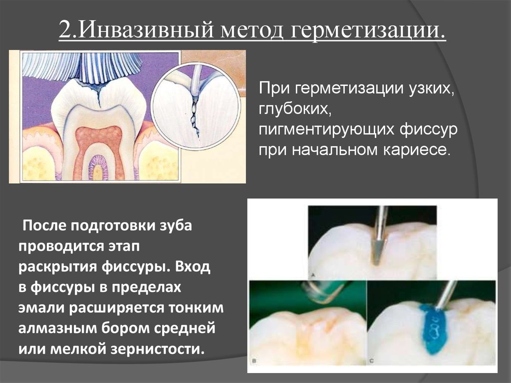 Герметизация фиссур виды Реставрация зубов Томск Бакунина