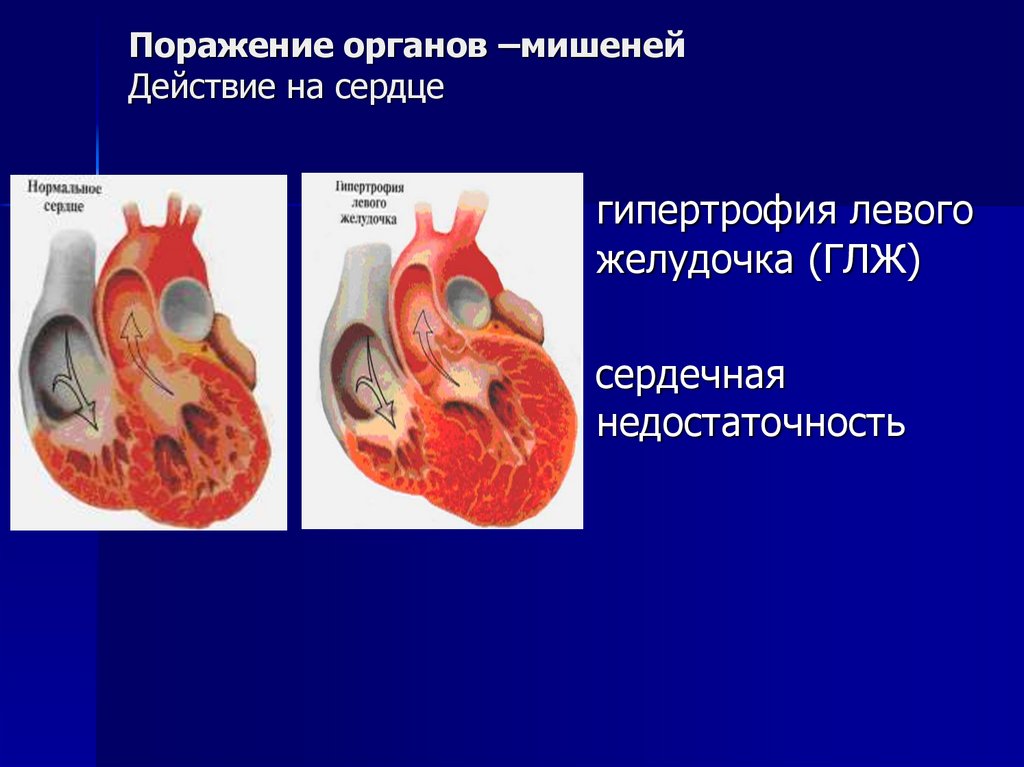 Поражение органов –мишеней Действие на сердце