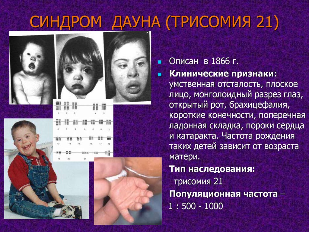 Причины заболевания дауна. Синдром Дауна трисомия по 21 хромосоме. Синдром Дауна трисомия 21 хромосомы. Синдром Дауна трисомия 21. Синдром Патау (трисомия по 13-й хромосоме).