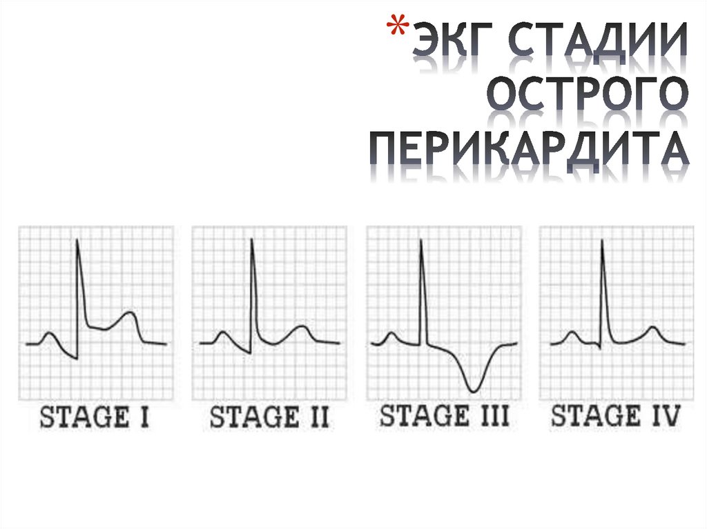 Экг степень