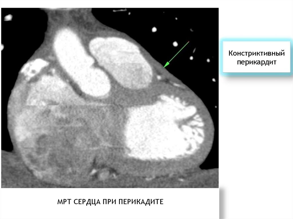 Выпотной перикардит. Выпотной и констриктивный перикардит. Констриктивный перикардит панцирное сердце. Экссудативный и констриктивный перикардит.