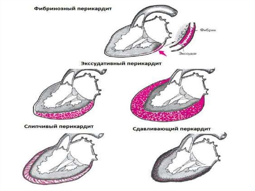 Выпотной перикардит