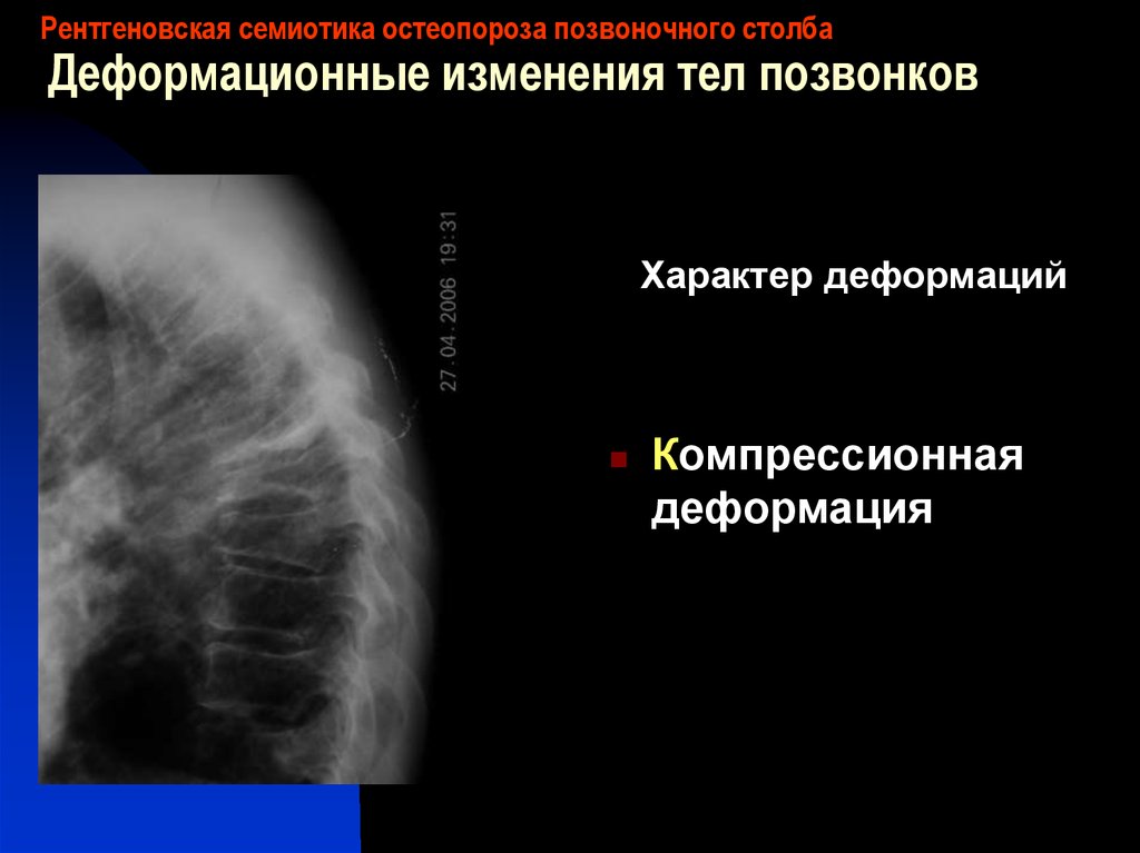 Компрессионная деформация тел позвонков. Рентгенодиагностика остеопороза. Рентгеновская семиотика это. Остеопоротические деформации тел позвонков.