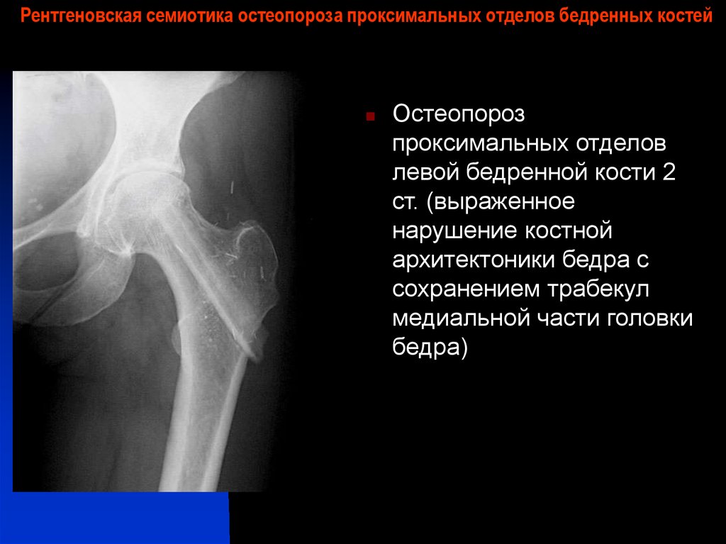 Проксимальный отдел бедренной кости. Тендиноз в области больших Вертелов бедренных костей. Остеопороз бедренной кости рентген. Остеопороз проксимального отдела бедренной кости. Остеопороз Вертелов бедренной кости.