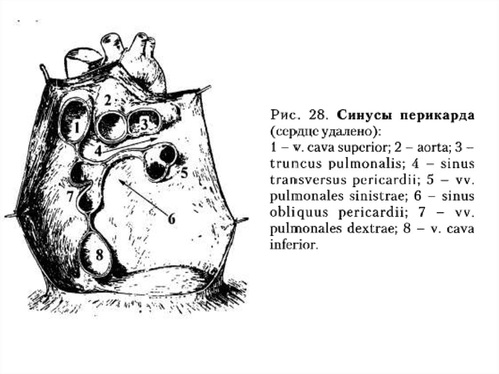 Передний нижний синус перикарда