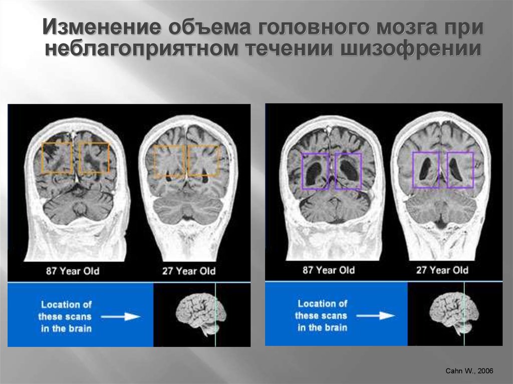 Атрофия мозга у взрослого. Изменения головного мозга. Снимок головного мозга при шизофрении. Изменения мозга при шизофрении.