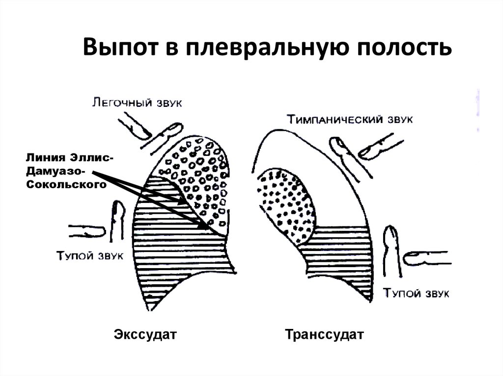 Плевральная полость рисунок