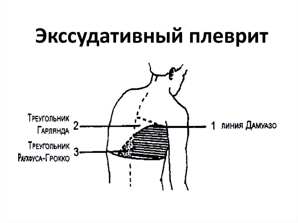 Перкуторная картина у больных с экссудативным плевритом