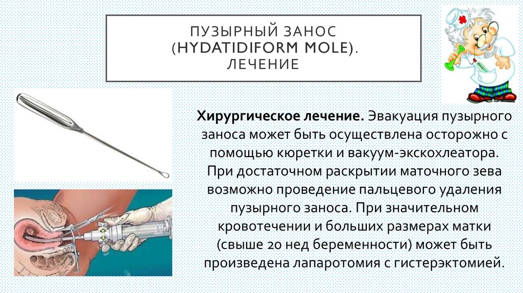 Кюретаж полости матки. Вакуум аспирация пузырный занос. Пузырный занос лечение. Пузырный занос презентация. Полный и неполный пузырный занос.