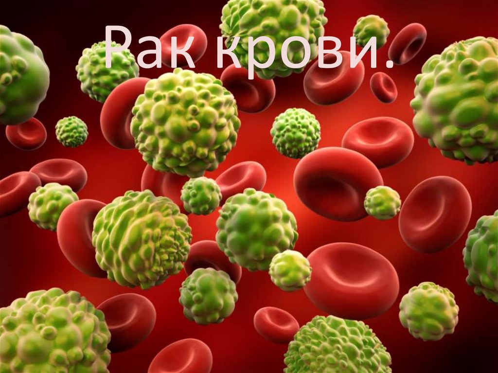 Рак крови.