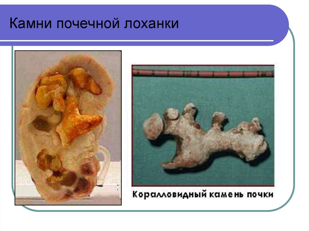 Нефролитиаз это. Камни почечной лоханки макропрепарат. Мочекаменная болезнь макропрепарат. Камень в лоханке почки макропрепарат. Мочекаменная болезнь коралловидные камни.