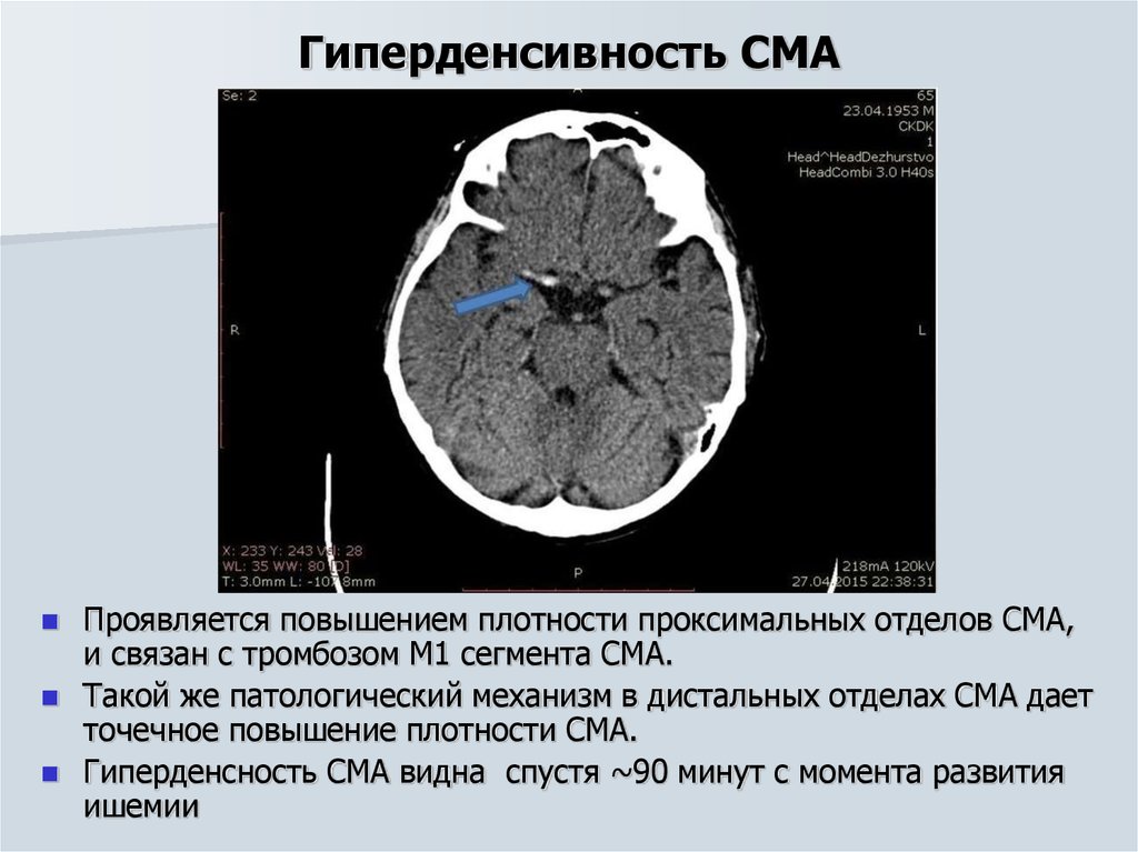 Сма мозга. Тромбоз средней мозговой артерии кт. М2 сегмент средней мозговой артерии кт. M1 сегмент СМА кт. Тромбоз м2 сегмента СМА кт.