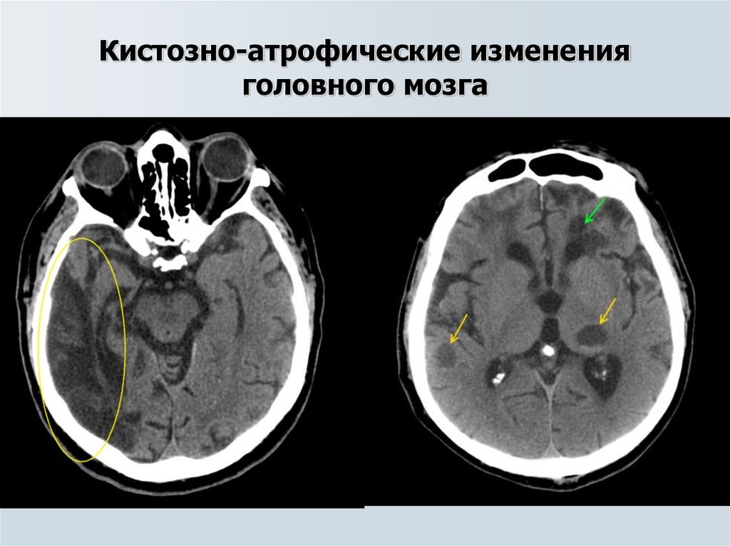 Умеренные атрофические изменения. Кистозно-глиозная трансформация головного мозга на кт. Кистозно-глиозная трансформация головного мозга что это такое. Кистозно-атрофические изменения головного. Кистозно-атрофические изменения головного мозга на кт.