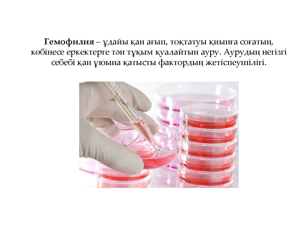 Гемофилия – ұдайы қан ағып, тоқтатуы қиынға соғатын, көбінесе еркектерге тән тұқым қуалайтын ауру. Аурудың негізгі себебі қан